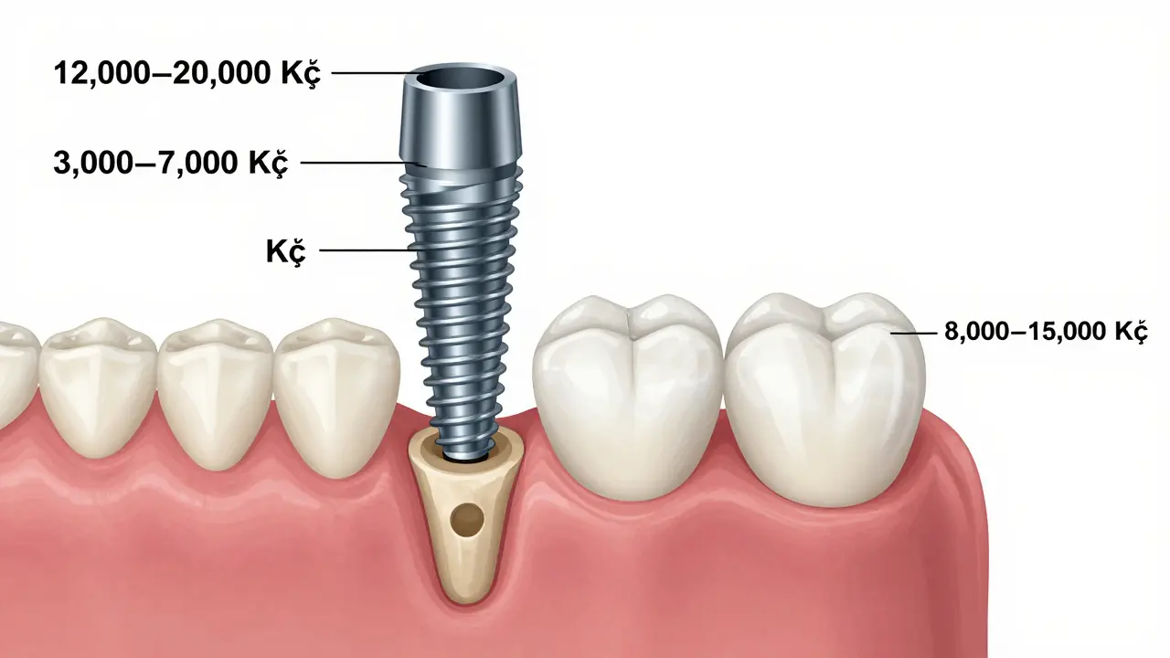 Diagram showing components of a dental implant with price ranges in Czech crowns.